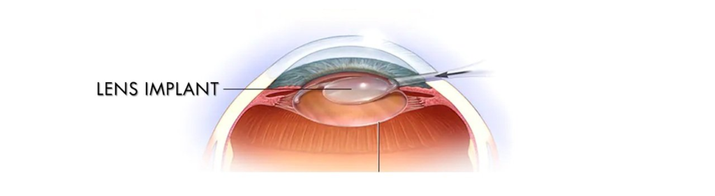 ohip cataract surgery coverage